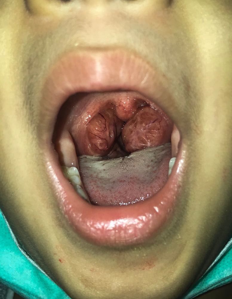person with enlarged tonsils