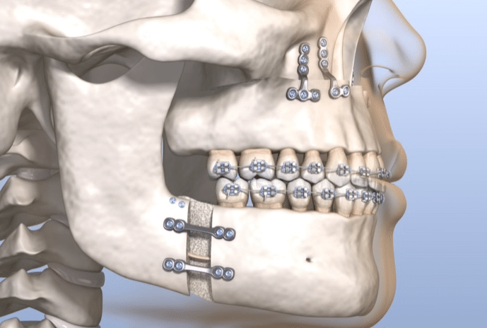 Illustration of Maxillomandibular Advancement