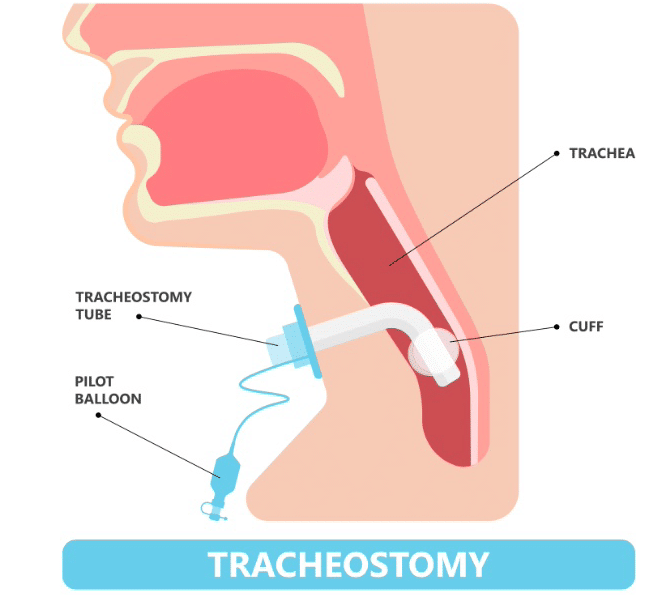 Illustration of how tracheostomy works