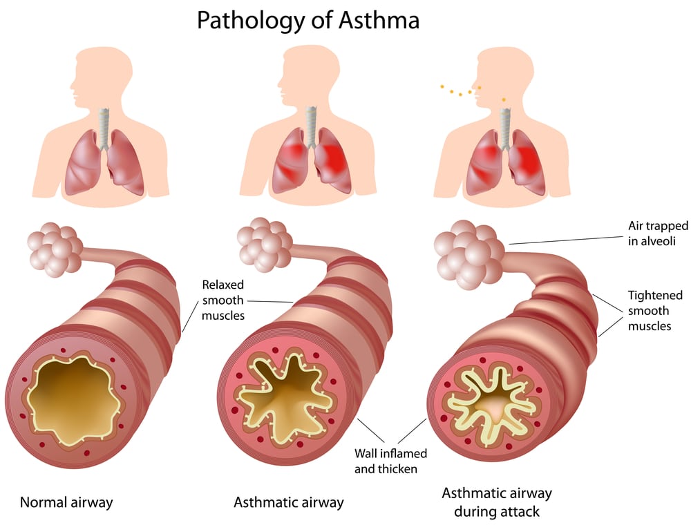 Image showing how asthma affects the lung and airway