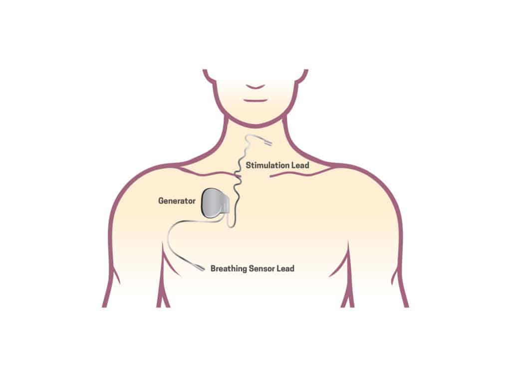 inspire implant placement