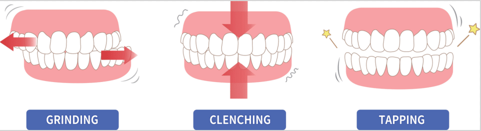 Bruxism is clenching, Grinding and Tapping