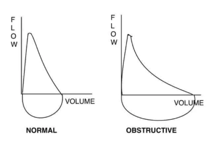 Flow volume loops showing normal lungs on the left and COPD on the right