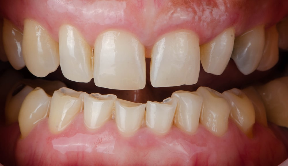 Tooth wear due to untreated bruxism