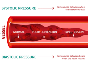 cutaway view of an artery with different levels of obstruction that leads to hypertension or high blood pressure